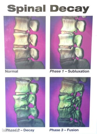 Poster anatomique plastifié 3 Phases de l’Arthrose